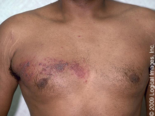 Serious Rashes Every Student and Clinician Should Know | skinsight